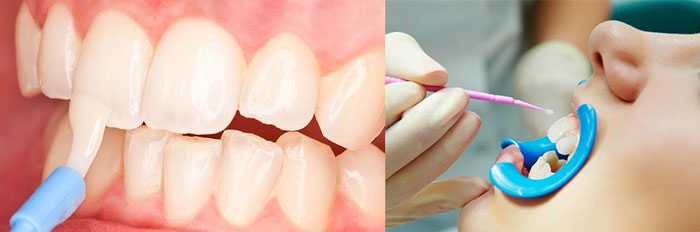 Лаки для зубов: виды, показания, способы применения, альтернативы