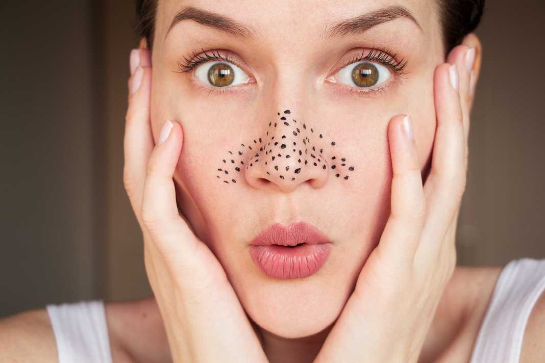 Узнайте, какие маски для глубокого очищения кожи лица лучше использовать в домашних условиях самодельные или покупные Обзор 3 рецептов и 5 косметических средств для очистки пор от черных точек
