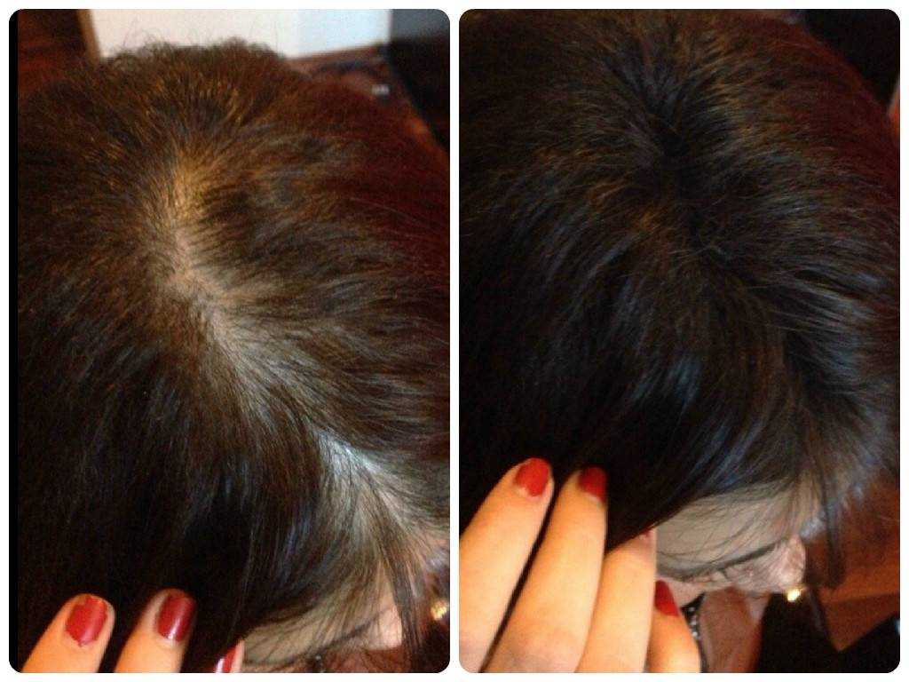 Выпадение волос от финастерида у женщин