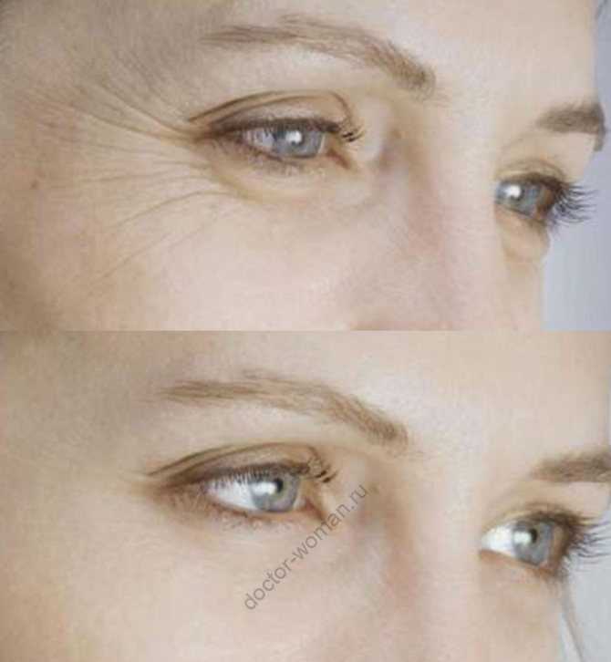 Prp — плазмотерапия — эффективный метод устранения пигментных пятен и темных кругов под глазами