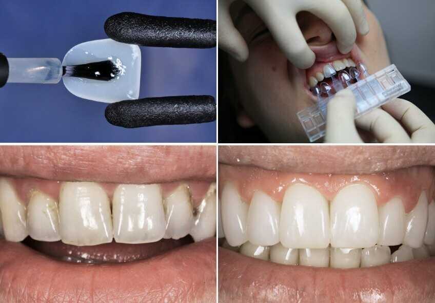 Косметическое отбеливание зубов: плюсы и минусы, стоит ли делать процедуру, противопоказания - dentika