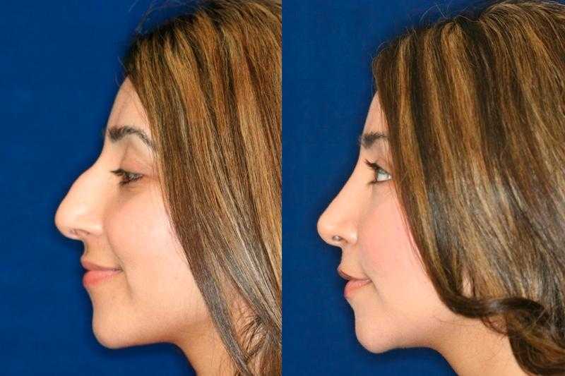 Люди доказывают, что большой нос — это красиво (14 фото)