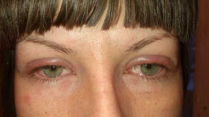 Аллергия на косметику - симптомы, причины, профилактика и лечение
