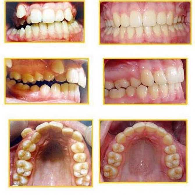 Чувствительность зубов – как убрать или уменьшить