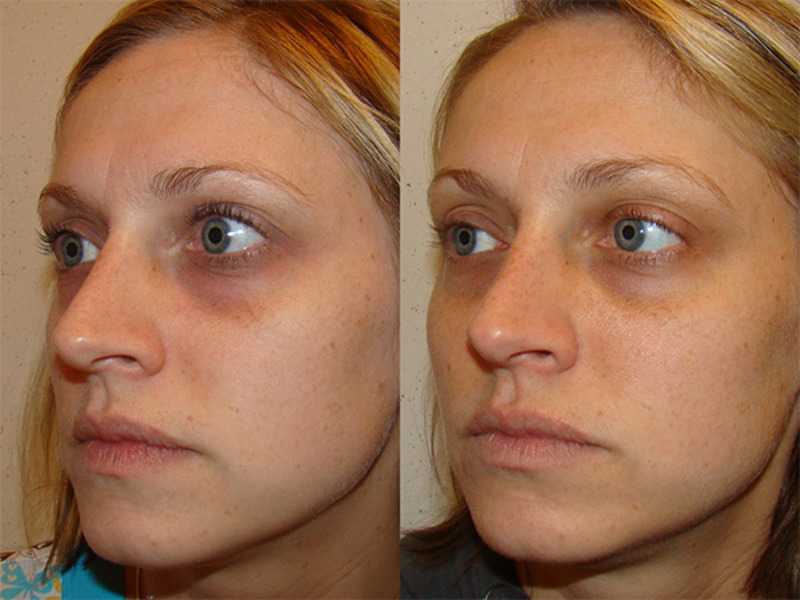 Подтяжка лица препаратом «radiesse» («радиесс») на основе гидроксиапатита кальция - клиника косметологии