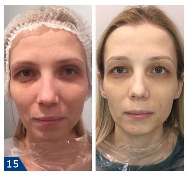 Почему американские косметологи рекомендуют пациентам старше 50 лет курс «profhilo» — нового препарата на основе гиалуроновой кислоты