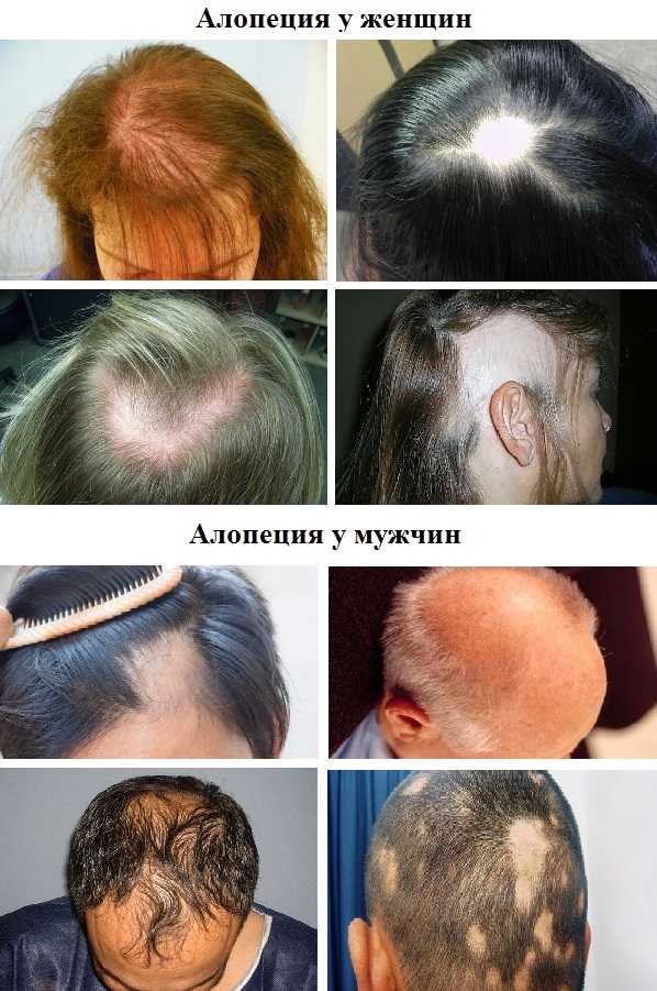 При выпадении волос какие шампуни советуют трихологи от | обзор лучших средств от выпадения волос
