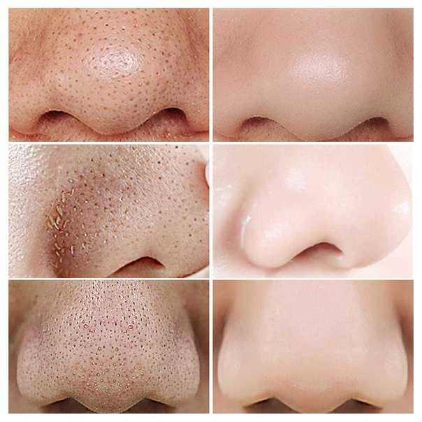 Очищение кожи лица: этапы и правила безопасного очищения