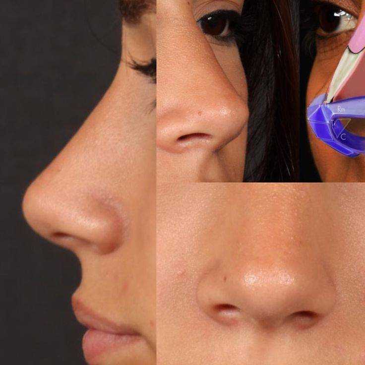 Как пластика носа меняет карму - всё о ринопластике