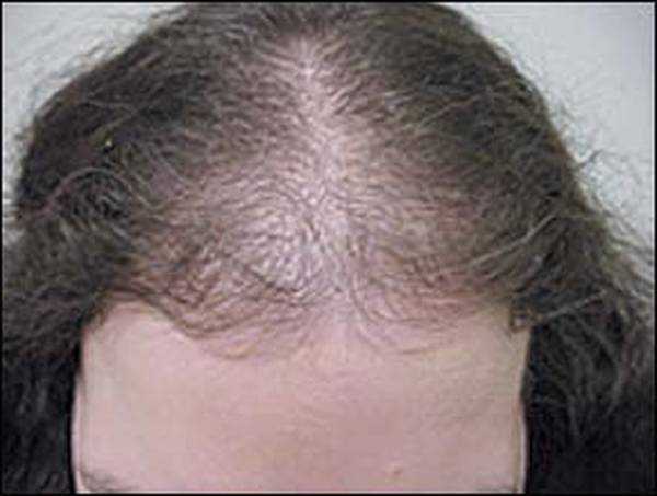 Выпадение волос не в андрогенной зоне