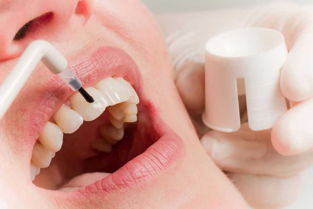 Fdi: использование фторидсодержащей зубной пасты для улучшения здоровья полости рта | стоматологическая ассоциация россии (стар) | официальный сайт