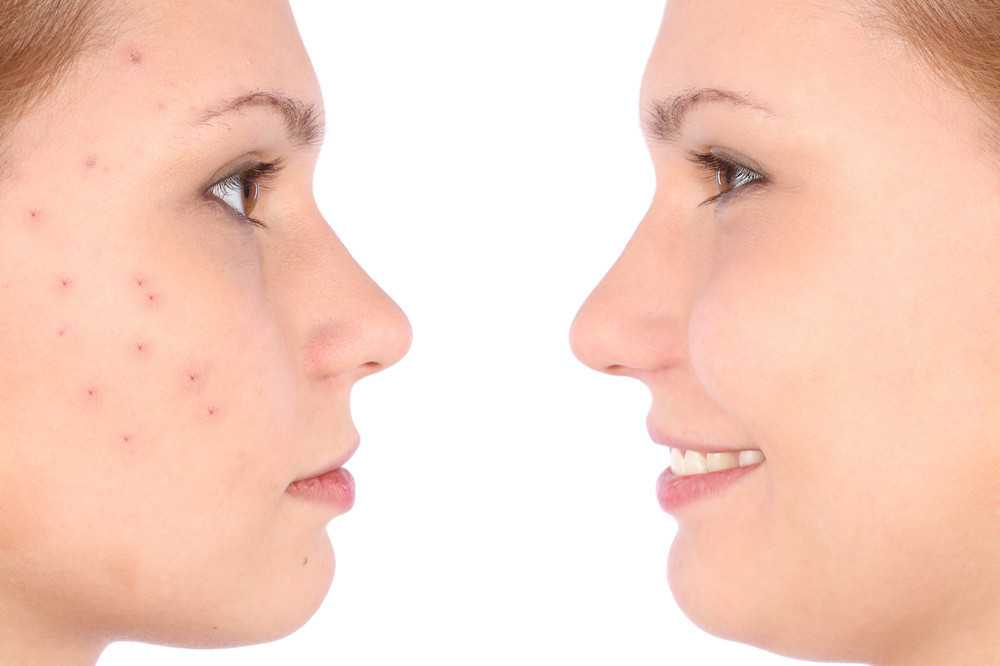 Аскорбиновая кислота для кожи лица - рецепты масок, уколы аскорбиновой кислоты в лицо