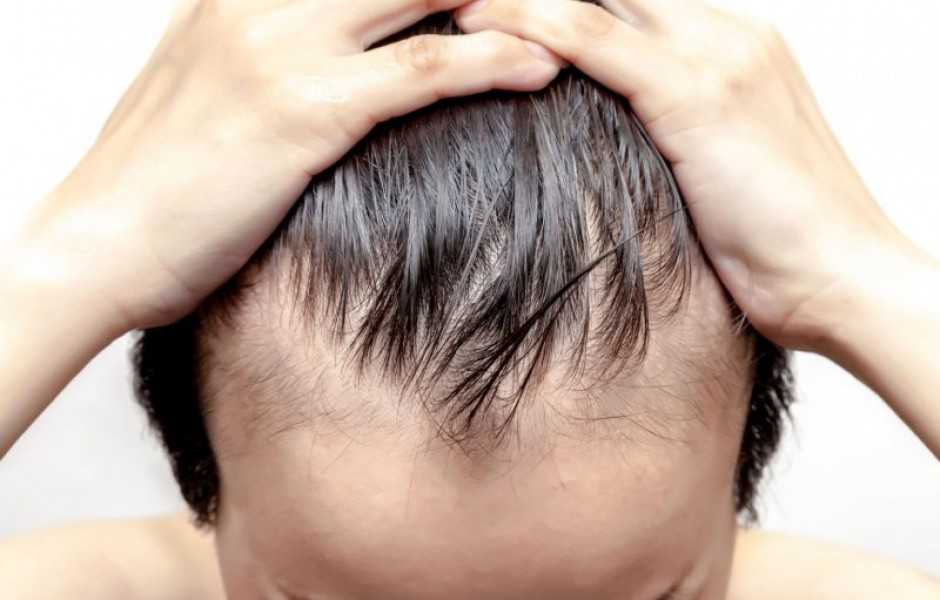 Лечение выпадения волос медикаментозными препаратами