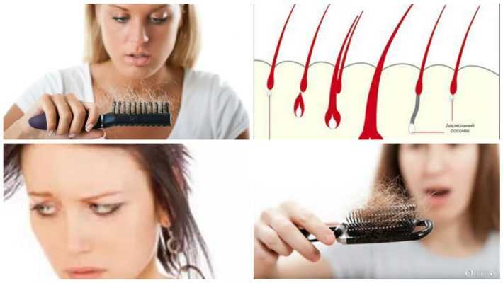 Выпадение волос у девушек: причины, лечение и профилактика