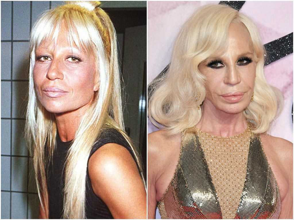 Фото неудачные пластические операции знаменитостей до и после