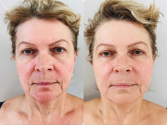 Биоревитализация кожи лица гиалуроновой кислотой: 10 причин сделать процедуру. косметическая процедура биоревитализация - womanem