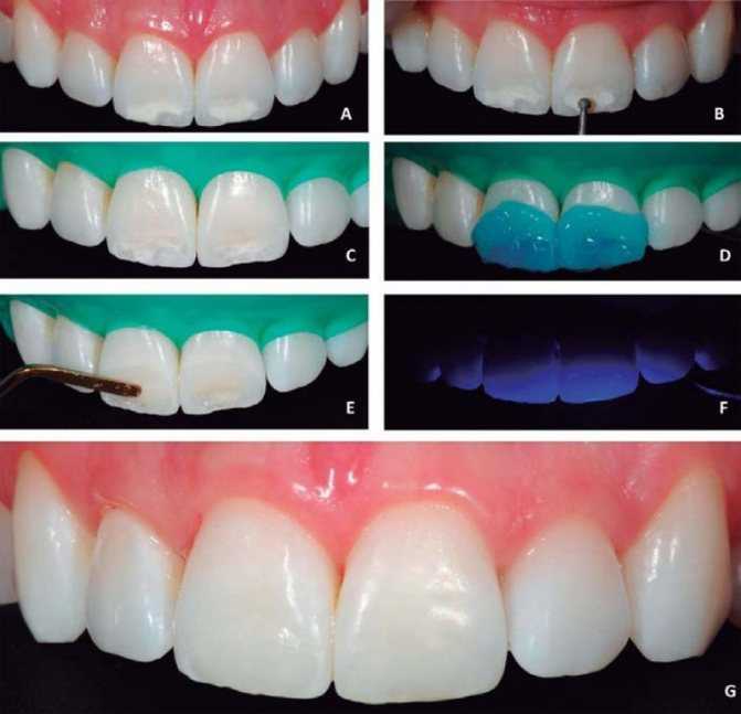 Зубные пасты для эмали зубов - восстановление и укрепление эмали