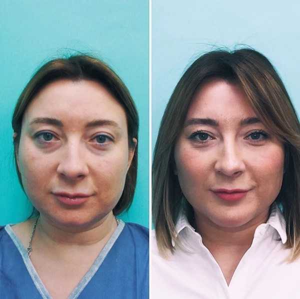 Комки биша - фото до и после операции, отзывы пациентов