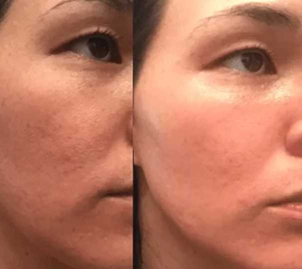Врачдерматокосметолог клиники Green Beauty Bar Юлия Елина рассказала, какие продукты изменяют состав липидов и как цинк восстанавливает кожу после акне