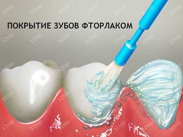 Фторирование зубов: все виды покрытия эмали фтором
