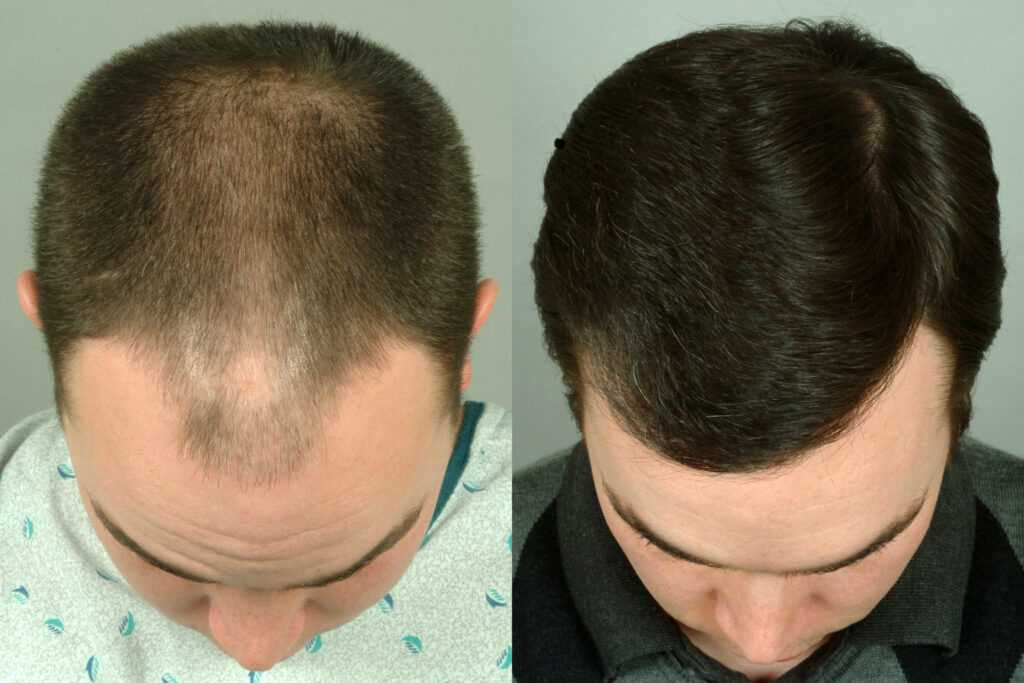 Процедуры для восстановления волос