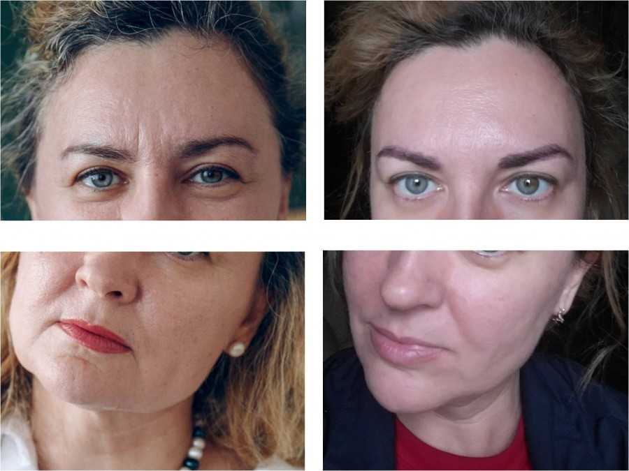 Койевая кислота и ее роль в осветлении кожи | svclinica - искусство современной косметологии!