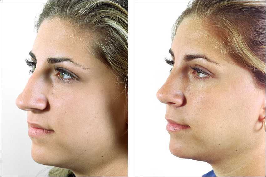 Как поднять кончик носа: способы коррекции без операции и с помощью пластической хирургии