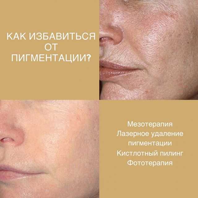 Врачдерматокосметолог клиники Green Beauty Bar Юлия Елина рассказала, какие продукты изменяют состав липидов и как цинк восстанавливает кожу после акне