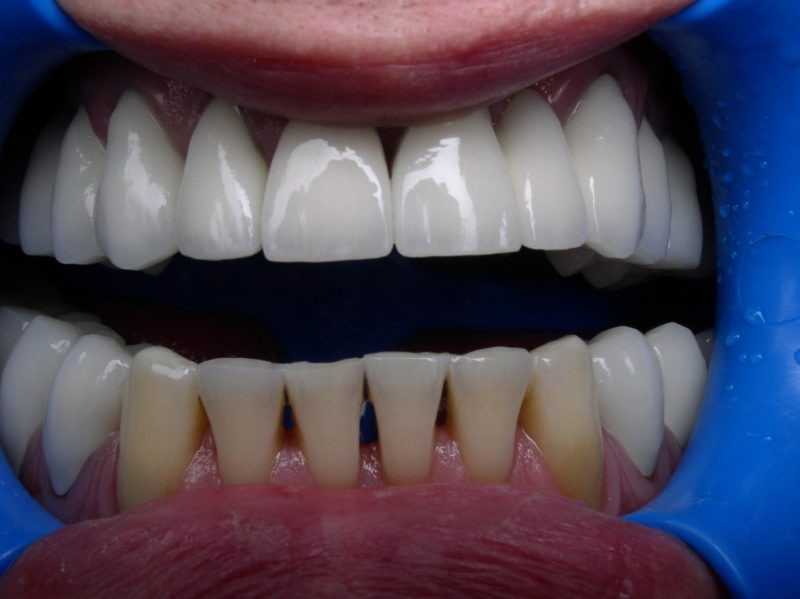 Фторид и его эффективность применения в стоматологии