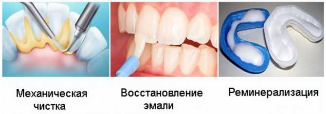 Фториды: механизм действия и рекомендации по применению. часть 2-я. - dentalmagazine.ru