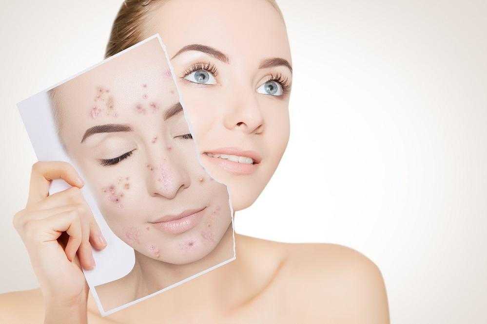 Уход за проблемной кожей лица: советы от экспертов