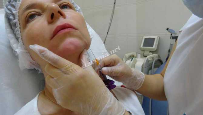 Почему американские косметологи рекомендуют пациентам старше 50 лет курс «profhilo» — нового препарата на основе гиалуроновой кислоты