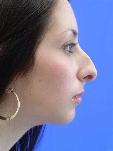Нос с горбинкой – причины образования, лечение у девушки и парня +фото
