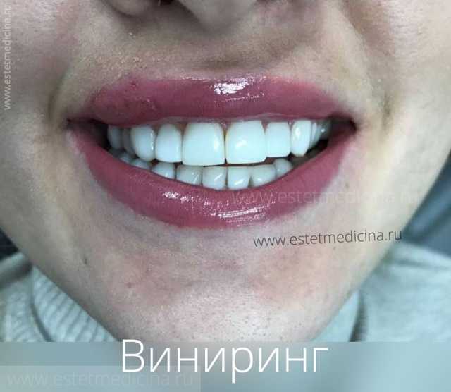 Как исправить зубы | журнал esquire.ru