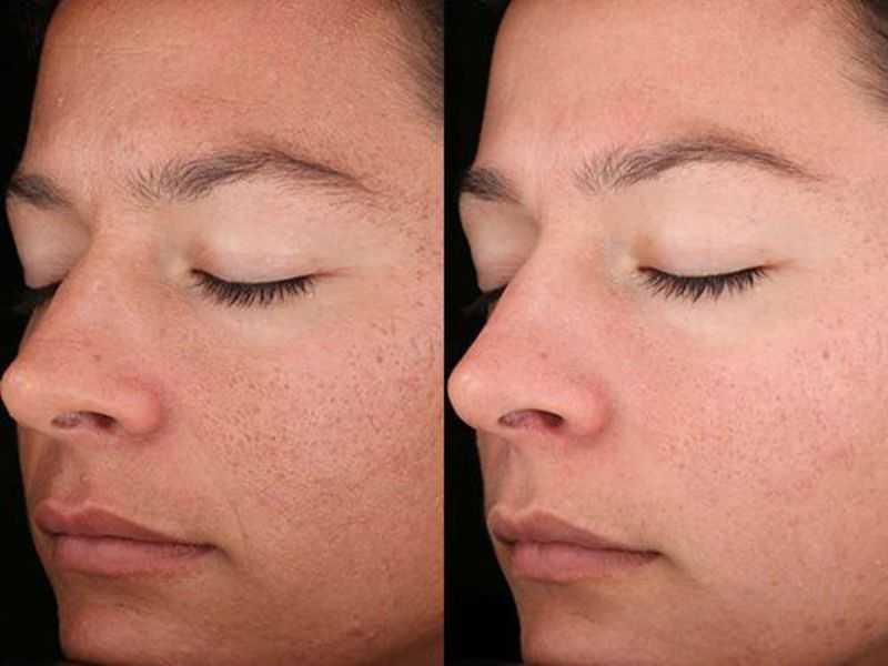 Карбоновый пилинг лица: что это такое, отзывы, фото до и после