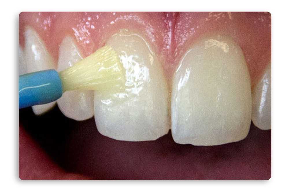 Средства, применяемые для насыщения поверхности зуба минеральными компонентами | "дентал классик" — стоматология в твери