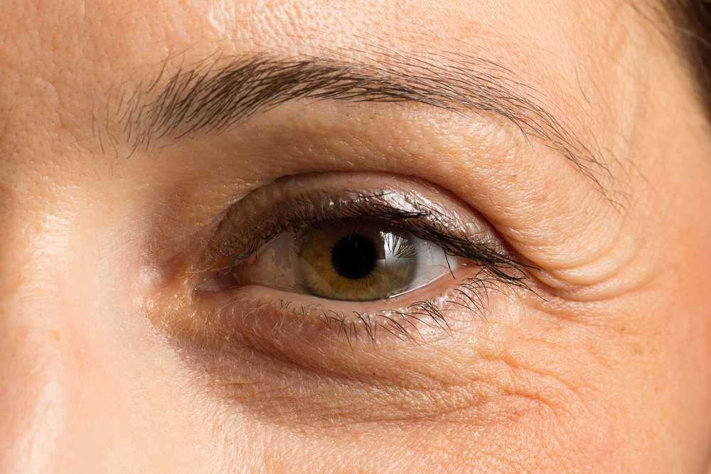 Мимические морщины вокруг глаз как избавиться после 25