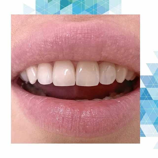 Плюсы и минусы косметического отбеливания зубов: стоит ли делать, показания и противопоказания к процедуре