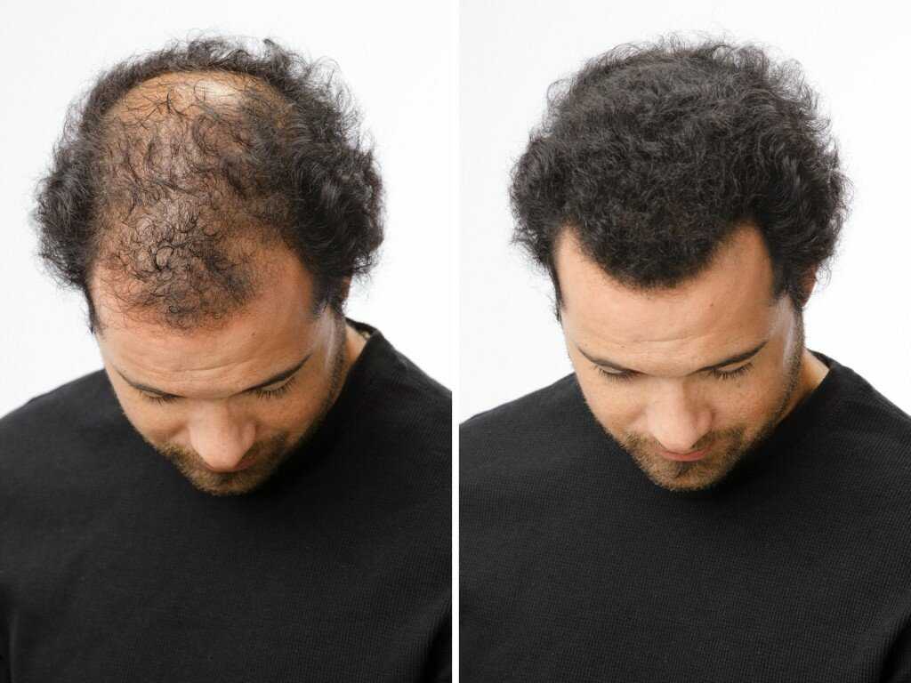 Cuanto crece el pelo en un mes hombre