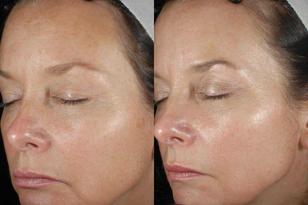 📎 лазерный пилинг кожи лица: эффект от пилинга лазером, показания и противопоказания