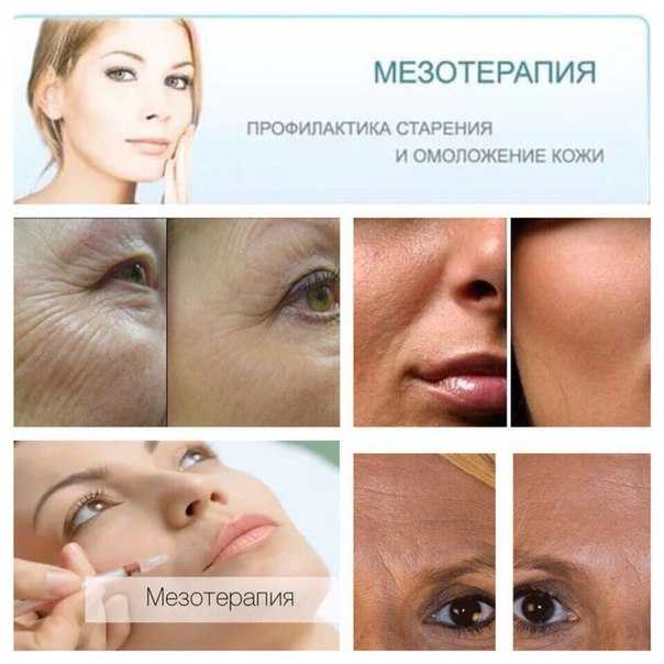 Курс «profhilo» – новый продукт для омоложения кожи на основе гиалуроновой кислоты - клиника косметологии