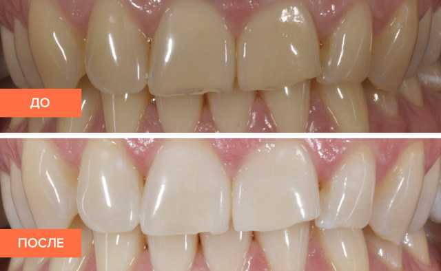 Как восстановить эмаль зубов – можно ли провести восстановление в домашних условиях