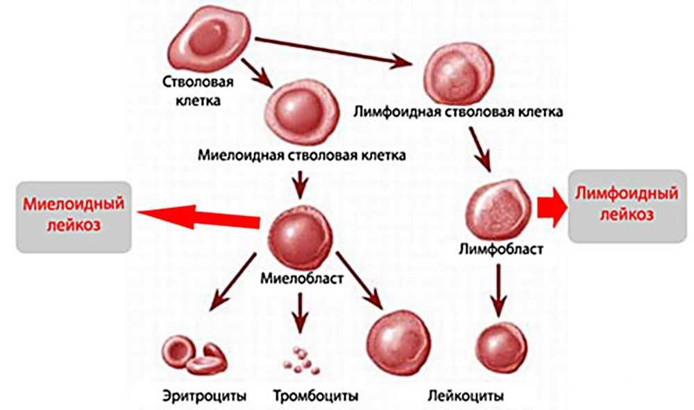 Рак крови (лейкоз): симптомы, современная диагностика, лечение рака крови лучевой и химиотерапией в стационаре и амбулаторно в санкт-петербурге
