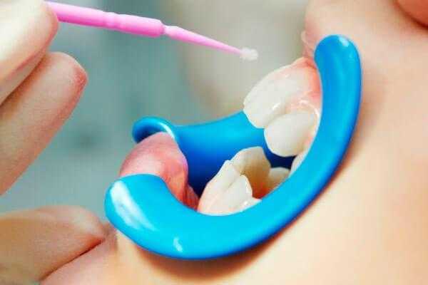 Средства, применяемые для насыщения поверхности зуба минеральными компонентами