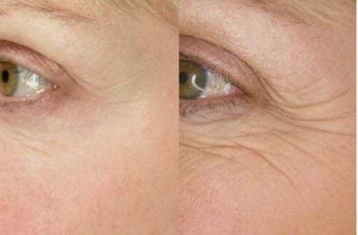 Морщины вокруг глаз: почему они появляются, как убрать в косметологии и в домашних условиях