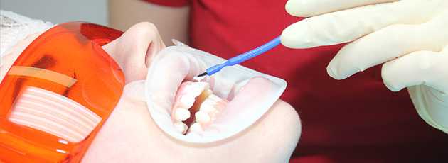 Зубные пасты для эмали зубов - восстановление и укрепление эмали