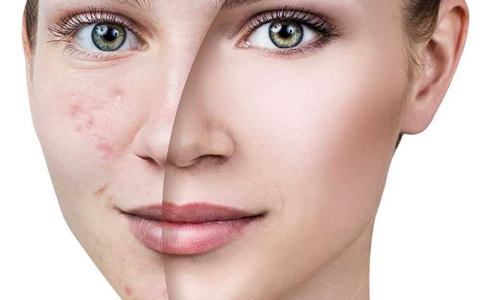 7 советов по выбору тональной основы для проблемной кожи | лечение акне и розацеа препаратом азелик