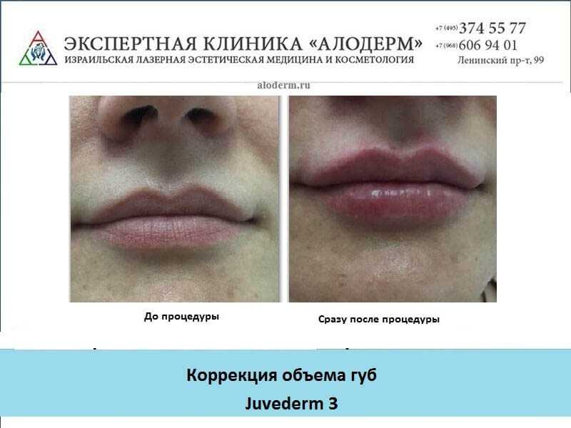 Массаж губ после гиалуроновой кислоты. Увеличение губ гиалуроновой кислотой. Увеличение губ вид сбоку.