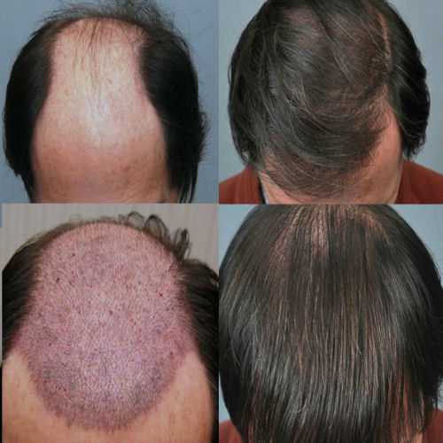 Предотвращение выпадения волос при химиотерапии солидных опухолей методом охлаждения кожи головы  | memorial sloan kettering cancer center