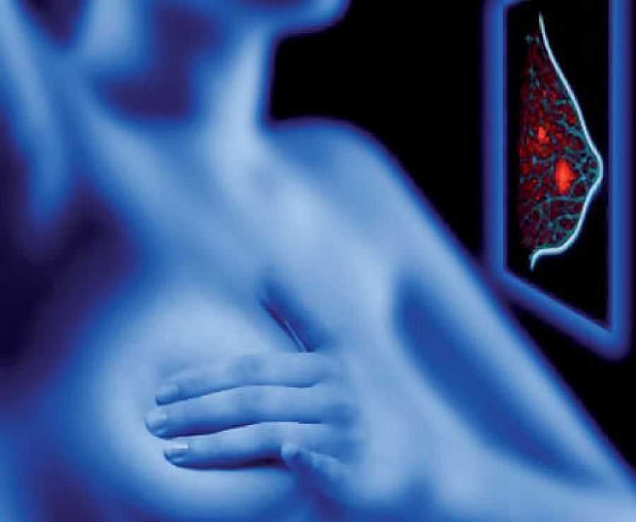 Рецидив рака молочной железы: как избежать вероятность рецидива рака груди после мастэктомии и какие могут быть признаки рецидива | проект «новая жизнь»